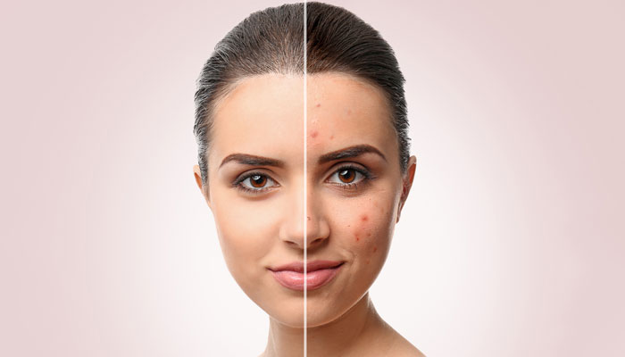Types of acne & acne scars
