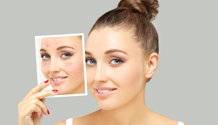 Best Acne Scar Removal Treatment