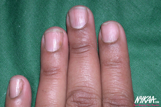 What your nails say about your health - 3