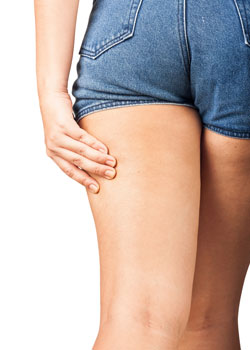what is cellulite