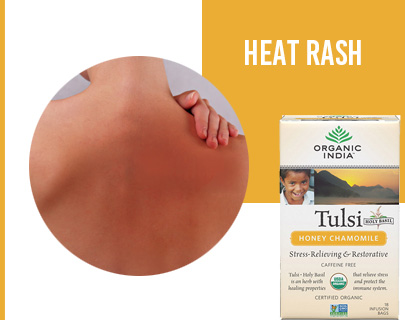 Summer Skin Care Tips- Heat Rash