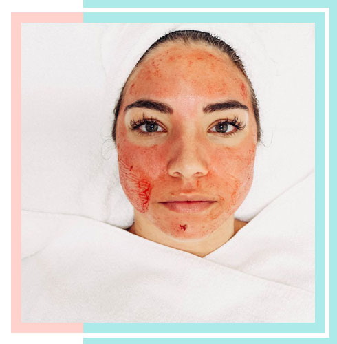 How To Get Glowing Skin in 2 Weeks- Platelet Rich Plasma