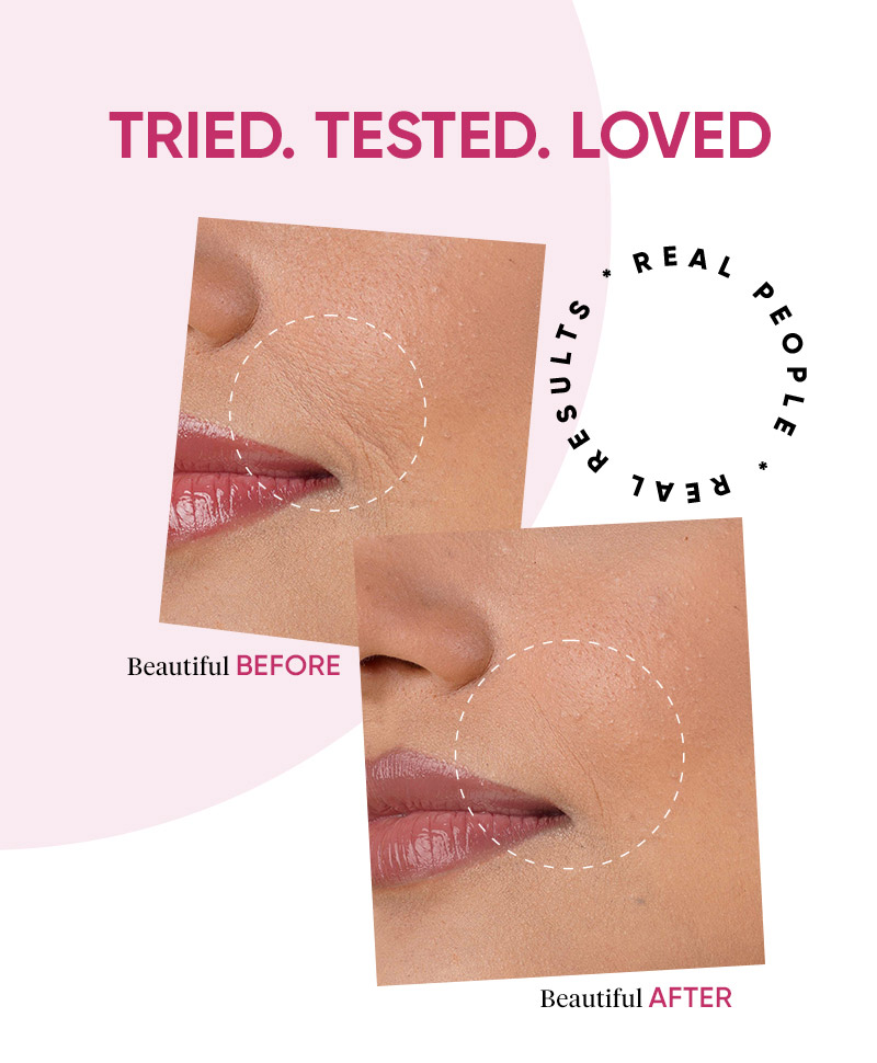 wrinkles, fine lines